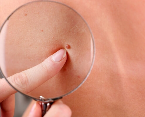 Dermatologist examines a birthmark of patient, close up